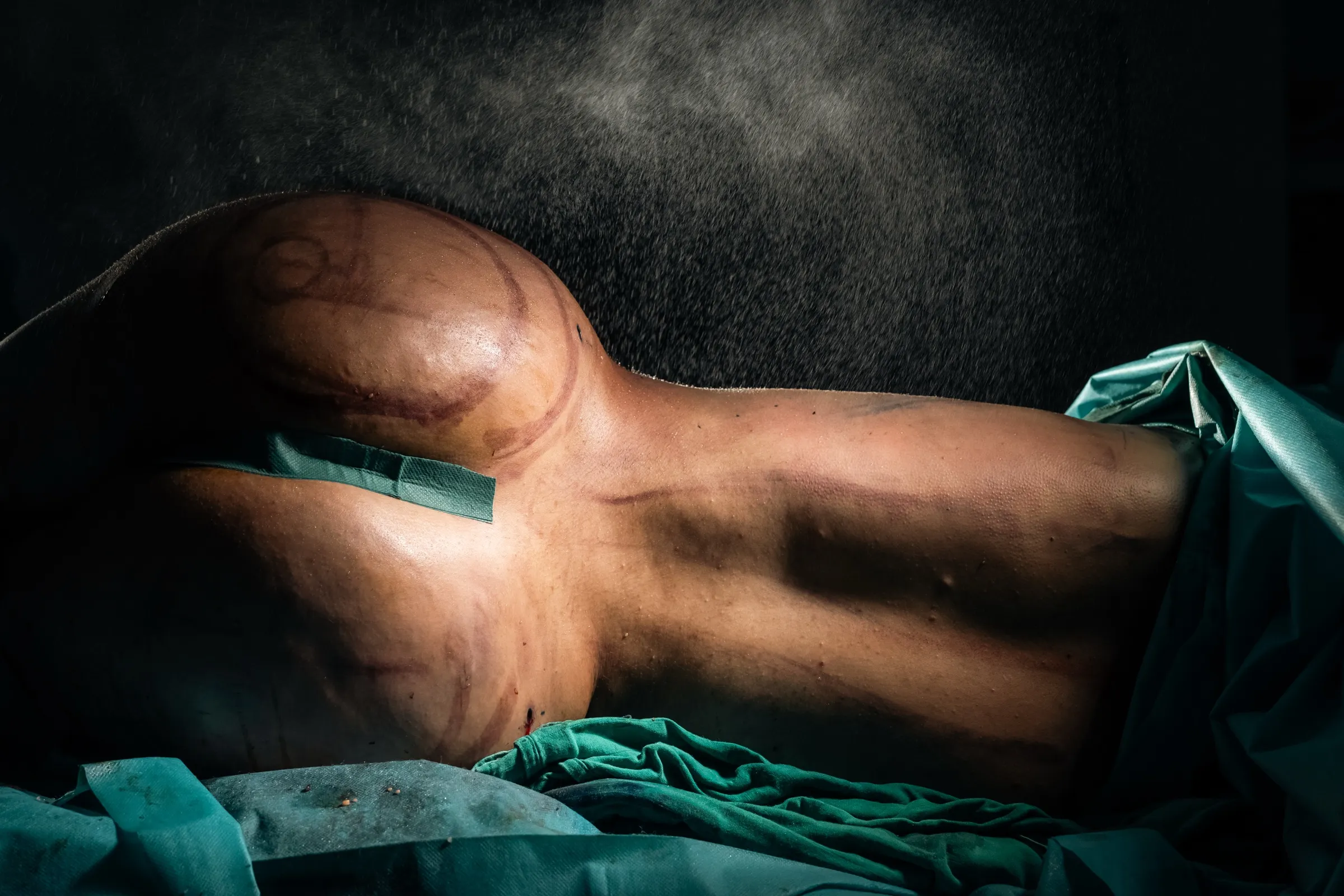 Pre-operative markings on a patient, lit like sculpture